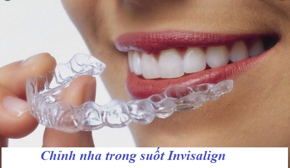 Chỉnh nha trong suốt Invisalign 