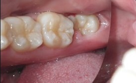 răng khôn 1