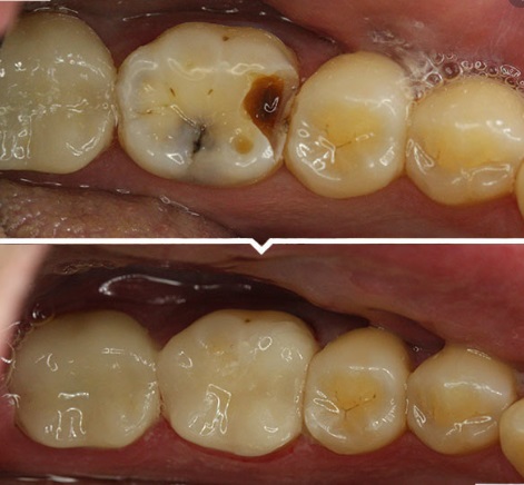 sâu răng trước và sau khi trám
