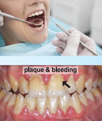 Chăm sóc răng miệng cho bệnh nhân ung thư
